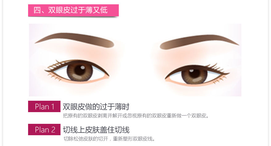 上海双眼皮医院排名_埋线双眼皮图片