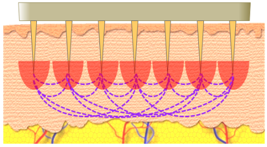 “Body Tite黄金微针射频”登陆华美，抗老技术再升级! - 上海华美医疗美容医院